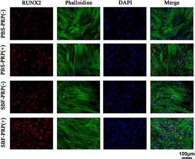 A Biomimetic Platelet-Rich Plasma-Based Interpenetrating Network Printable Hydrogel for Bone Regeneration